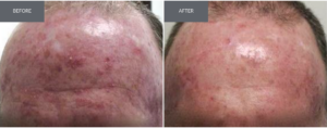 Before and after image of a man using niacinamide for sun damage consistently for three months.