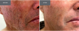 Before and after image of a man using niacinamide for sun damage consistently for three months.