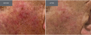 Before and after image of a man using niacinamide for sun damage consistently for three months.